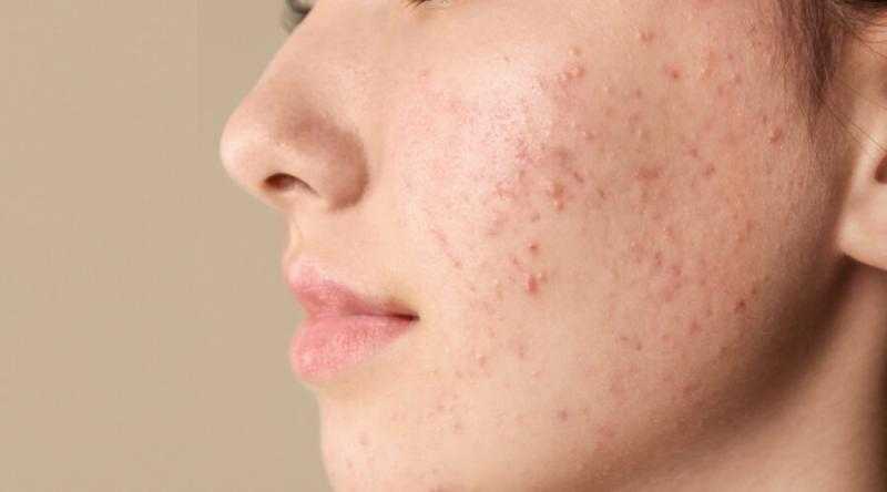 أطعمة تسبب حب الشباب