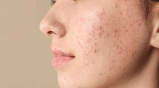 أطعمة تسبب حب الشباب