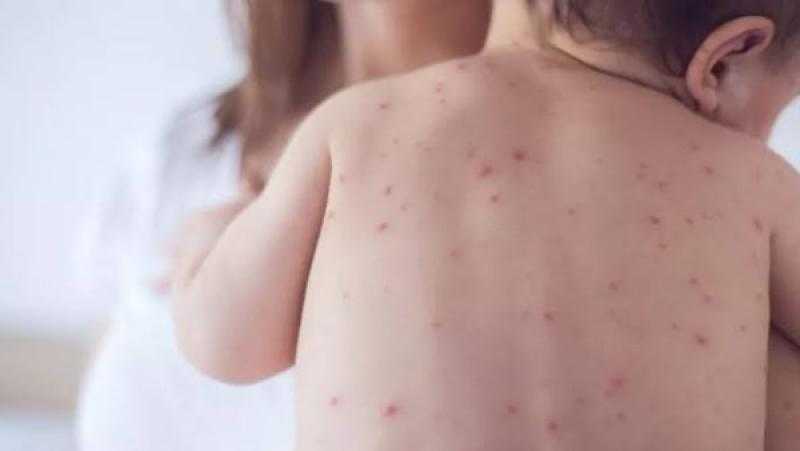 عاجل.. تفشي مرض خطير في إسرائيل والأطباء