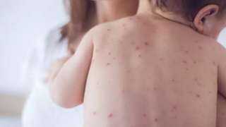 عاجل.. تفشي مرض خطير في إسرائيل والأطباء