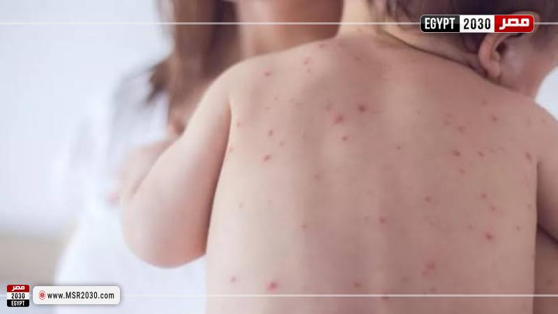 عدوى مرضى الحصبة