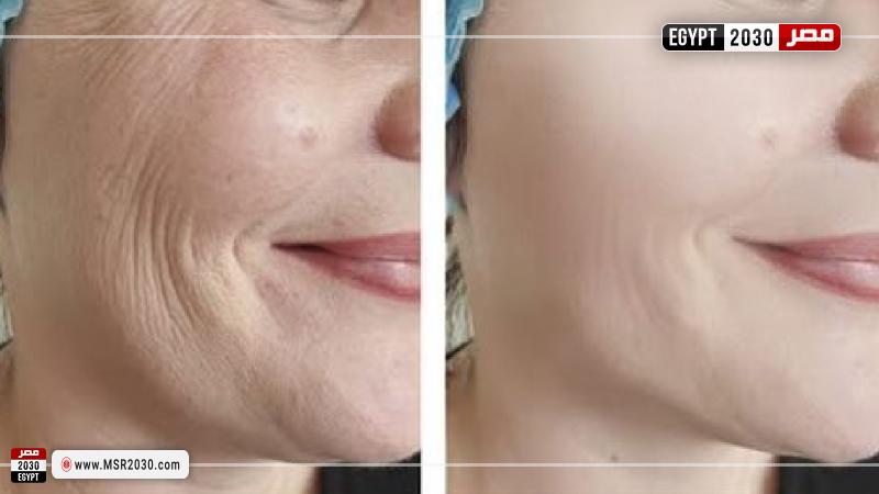 تجاعيد البشرة 