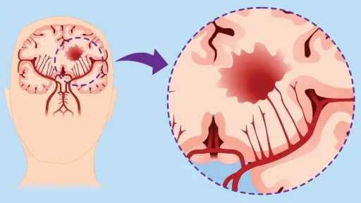 تعرف على أعراض سرطان الدماغ.. تفاصيل
