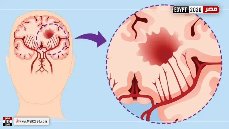 سرطان الدماغ 
