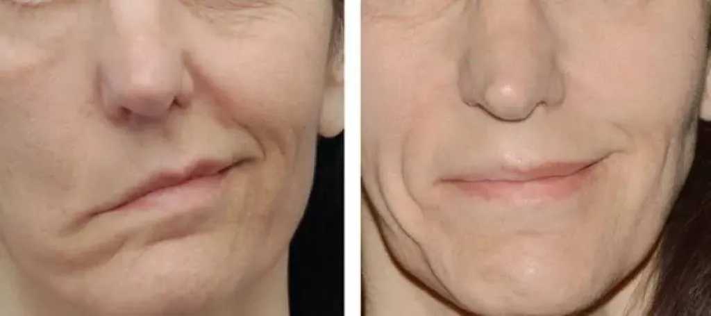 بعد إصابة الفنانة لقاء سويدان.. كل ما تود معرفته عن العصب السابع