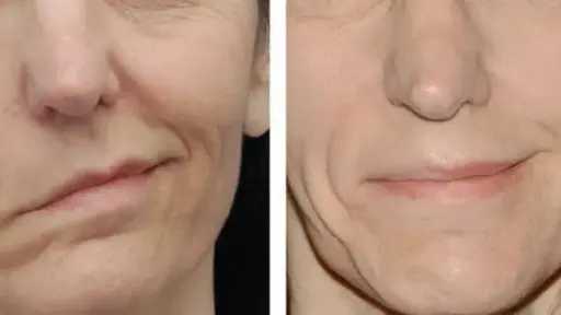 بعد إصابة الفنانة لقاء سويدان.. كل ما تود... بعد إصابة الفنانة لقاء سويدان.. كل ما تود معرفته عن العصب السابع