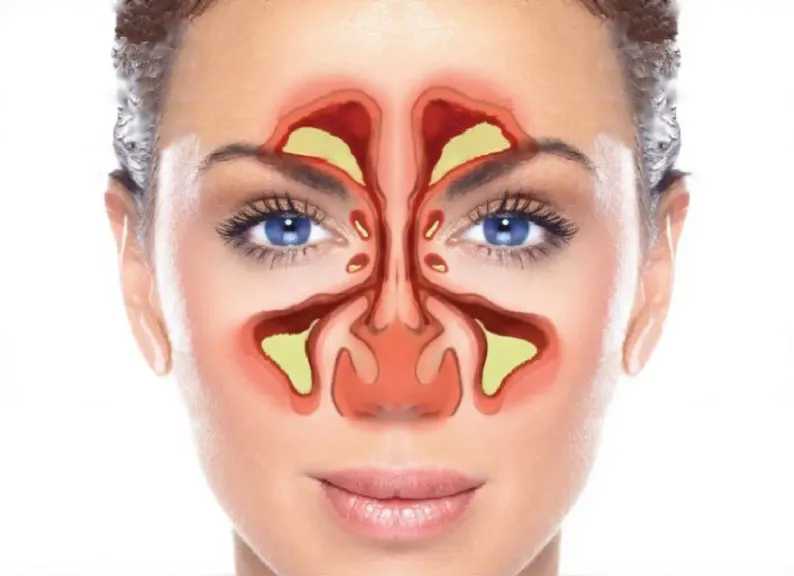 التهاب الجيوب الأنفية: الأسباب والأعراض