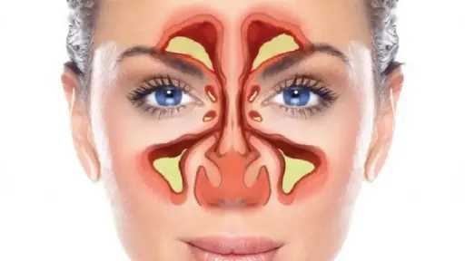 التهاب الجيوب الأنفية: الأسباب والأعراض