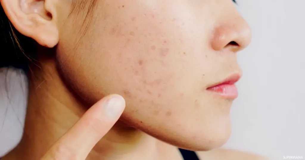 6 وصفات طبيعية تقلل التصبغات