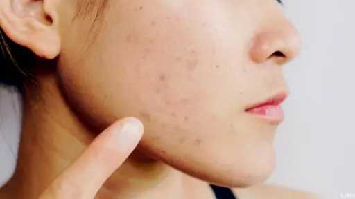 6 وصفات طبيعية تقلل التصبغات