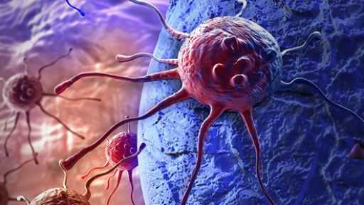 استشاري أورام: خسارة 10% من الوزن تقلل احتمالات الإصابة بالسرطان