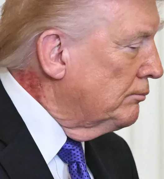 البيت الأبيض يصدر بيانا حول طفح جلدي ظهر على رقبة ترامب