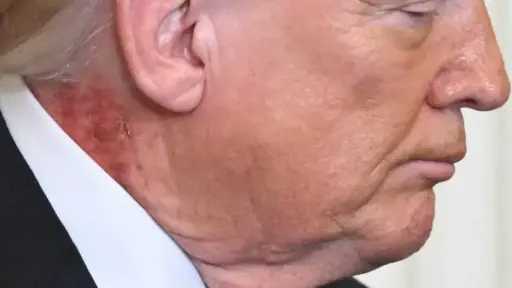 البيت الأبيض يصدر بيانا حول طفح جلدي ظهر على رقبة ترامب