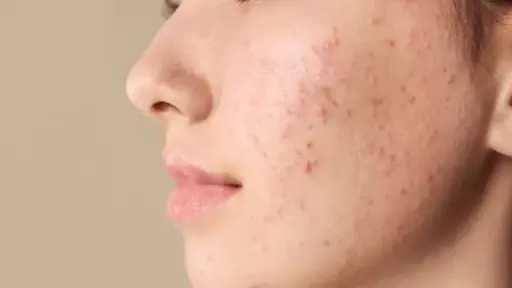 بمكونات اقتصادية.. حيل فعالة لعلاج «حب الشباب »