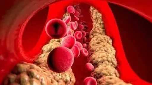 الدهون الثلاثية.. متى تتحول من مصدر طاقة إلى خطر يهدد القلب؟