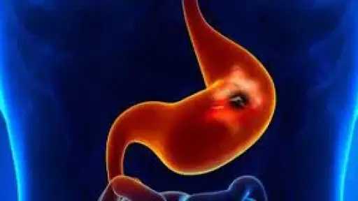 كل ما تود معرفته عن قرحة المعدة كل ما تود معرفته عن قرحة المعدة