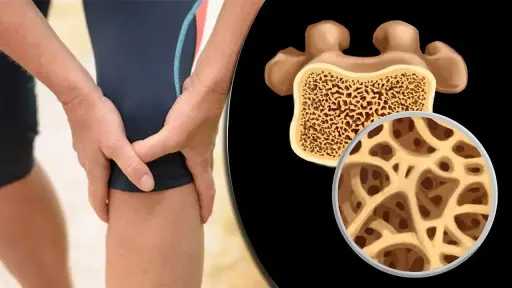 كل ما تود معرفته عن هشاشة العظام