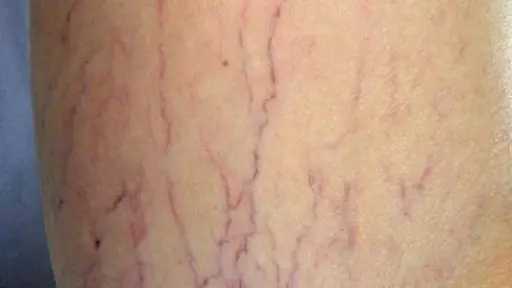 علاجات طبيعية لتخفيف دوالي القدمين