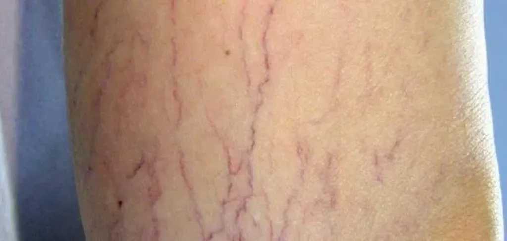 كل ما تود معرفته عن دوالي الساقين