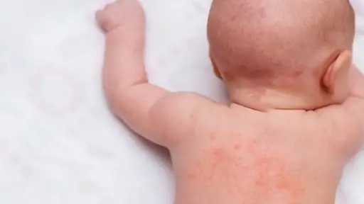 حمو النيل في الصيف.. طرق منزلية بسيطة لتهدئة الطفح الحراري سريعًا