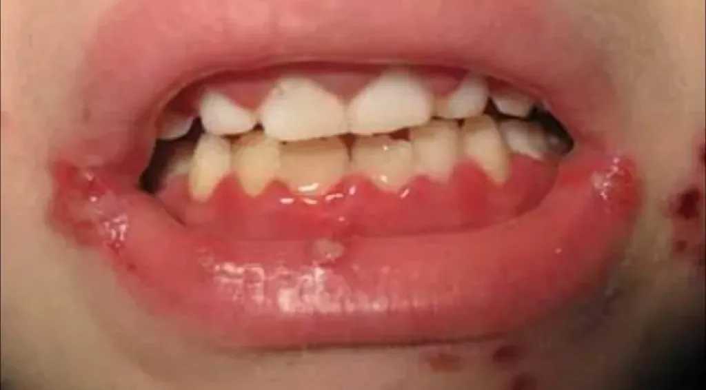 أعراض فيروس الهربس.. منها بثور الفم إلى مضاعفات العين والدماغ