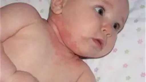 حمو النيل في الصيف.. طرق بسيطة للعلاج والوقاية من الطفح الجلدي